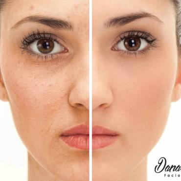 Rejuvenecimiento Facial IPL
