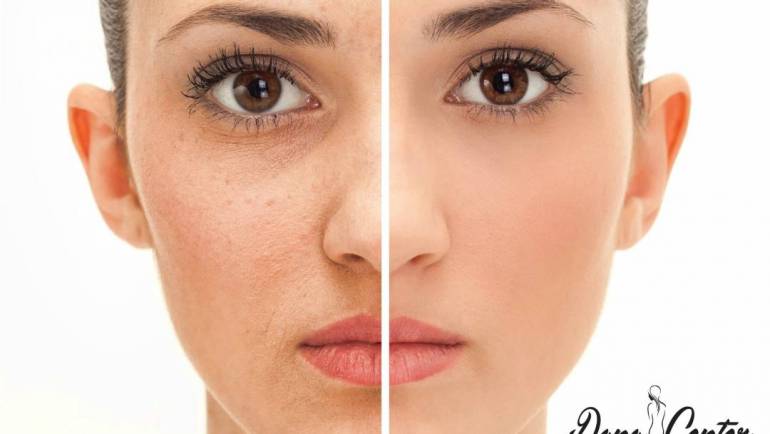 Rejuvenecimiento Facial IPL